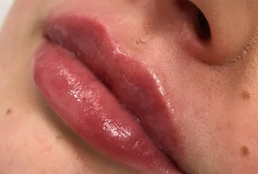 L  Lip & Dermal fillers are designed to enhance your lip shape, increase lip fullness and can help improve symmetry....
